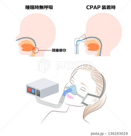 睡眠時の持続陽圧呼吸療法(COAP) 睡眠時の持続陽圧呼吸療法(COAP) 136283029