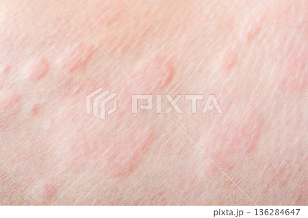 Skin allergy rash dermatitis texture close up background Skin allergy rash dermatitis texture close up background 136284647