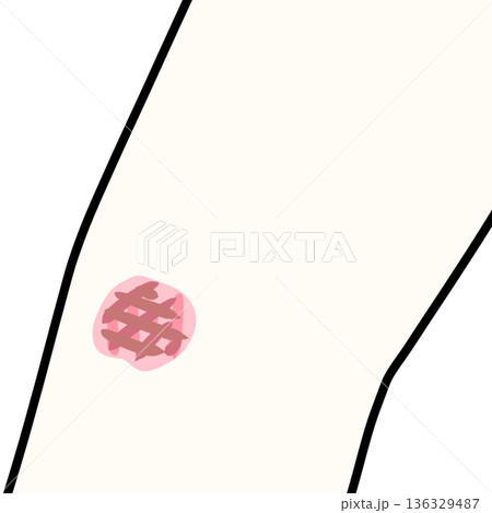 擦り傷 136329487