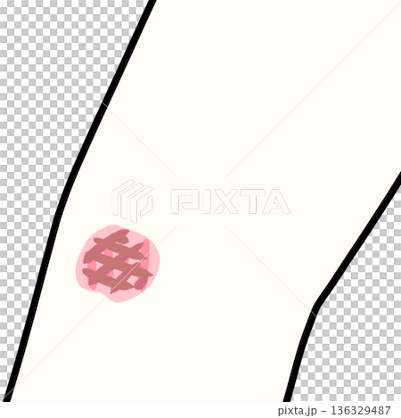 擦り傷 136329487