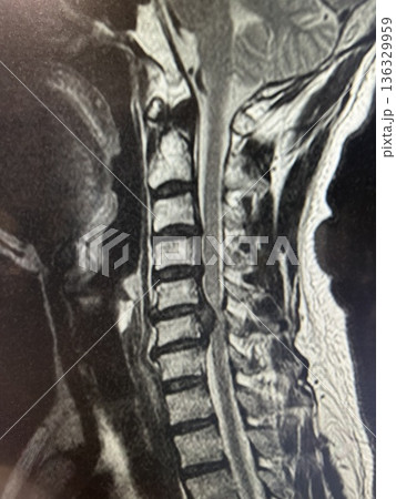 頸椎ヘルニア 136329959