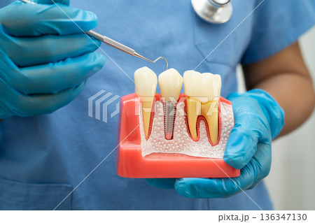 Dentist holding dental implant, artificial tooth roots into jaw, root canal of dental treatment, gum disease, teeth model for dentist. 136347130