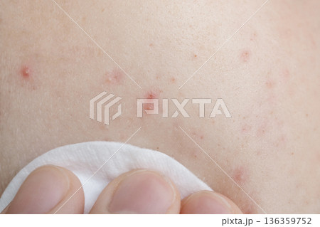 Hand applies skincare treatment to person's skin managing acne and pimples Hand applies skincare treatment to person's skin managing acne and pimples 136359752