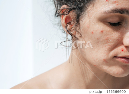 Portrait of a female with pimples and red acne on face in close-up on a white background. A woman with problematic skin 136366600