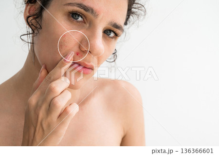 Portrait of a young girl with pimples and red acne on face close up on a white background. Woman with problematic skin. Collage of problem skin before and after treatment and care 136366601
