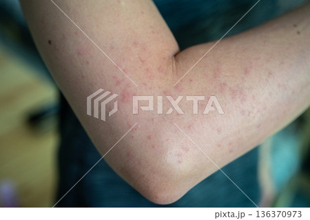 Cropped shot view of rashes occur on woman arm. A rash on your arms can occur due to an allergic reaction, contact with irritants, infection, or an underlying medical condition like psoriasis. 136370973