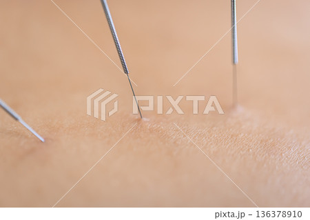 Dry needling acupuncture needles on patient, close up. Dry needling acupuncture needles on patient, close up. 136378910