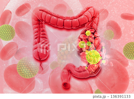 Colon cancer 136391133