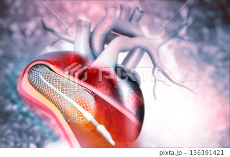 Human heart angioplasty Human heart angioplasty 136391421