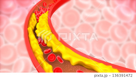 Artery blocked with bad cholesterol Artery blocked with bad cholesterol 136391472