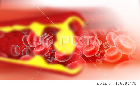 Artery blocked with bad cholesterol Artery blocked with bad cholesterol 136391479