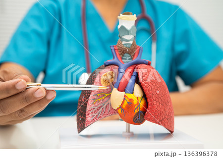 Pneumonia, lung cancer, Asian doctor holding human model. Pneumonia, lung cancer, Asian doctor holding human model. 136396378