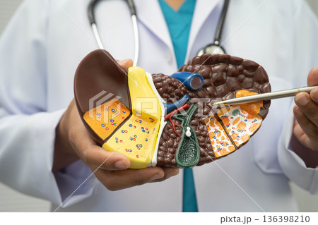 Cirrhosis, Liver cancer, fatty liver, Asian doctor with liver human model. Cirrhosis, Liver cancer, fatty liver, Asian doctor with liver human model. 136398210