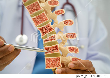 Doctor holding osteoporosis in back bone model for treatment medical in orthopedic department. 136403638