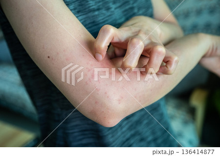 Cropped shot view of woman scratching her skin after rashes occur. A rash on your arms can occur due to an allergic reaction, contact with irritants, infection, or an underlying medical condition like Cropped shot view of woman scratching her skin after rashes occur. A rash on your arms can occur due to an allergic reaction, contact with irritants, infection, or an underlying medical condition like 136414877