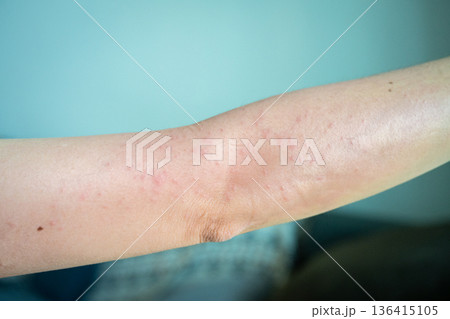 Cropped shot view of rashes occur on woman arm. A rash on your arms can occur due to an allergic reaction, contact with irritants, infection, or an underlying medical condition like psoriasis. 136415105