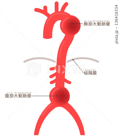 大動脈瘤のイラスト　Illustration of an aortic aneurysm 136416334