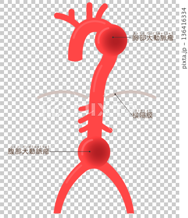 大動脈瘤のイラスト　Illustration of an aortic aneurysm 136416334