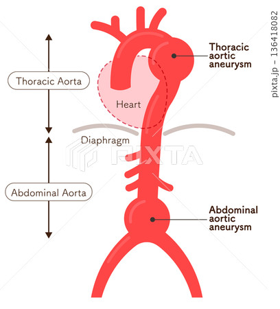大動脈瘤のイラスト　Illustration of an aortic aneurysm 136418082