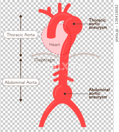 大動脈瘤のイラスト　Illustration of an aortic aneurysm 136418082