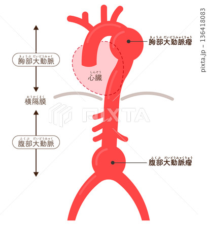 大動脈瘤のイラスト Illustration of an aortic aneurysm 大動脈瘤のイラスト Illustration of an aortic aneurysm 136418083