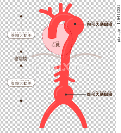 大動脈瘤のイラスト Illustration of an aortic aneurysm 大動脈瘤のイラスト Illustration of an aortic aneurysm 136418083