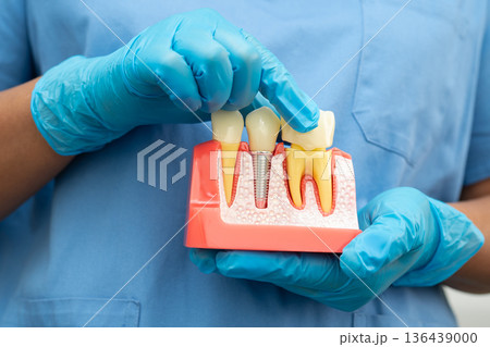 Teeth root dental model with tool for dentist use to cleaning care treatment. Teeth root dental model with tool for dentist use to cleaning care treatment. 136439000