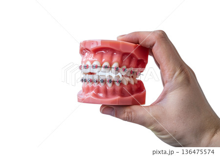 Hand holding dental teeth model with metal braces, perfect for orthodontic education, dentist offices, and smile makeover concepts 136475574
