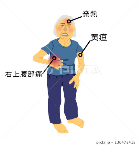 急性胆管炎(シャルコー三徴)|発熱・黄疸・右上腹部痛の症状イラスト 急性胆管炎(シャルコー三徴)|発熱・黄疸・右上腹部痛の症状イラスト 136478418