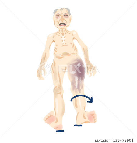 大腿骨転子部骨折の身体所見｜外旋位・短縮・皮下出血・起き上がり困難イラスト 136478901