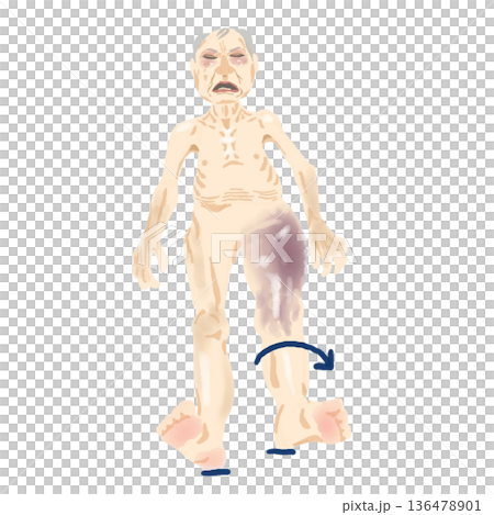 大腿骨転子部骨折の身体所見｜外旋位・短縮・皮下出血・起き上がり困難イラスト 136478901