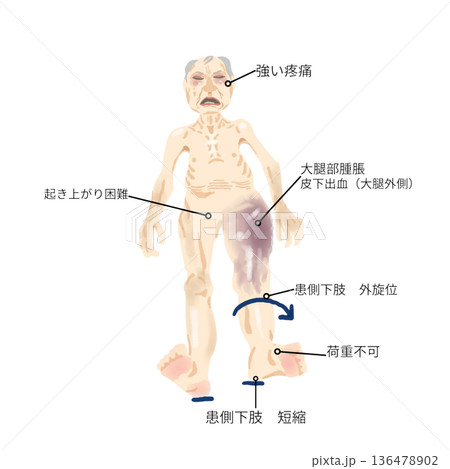 大腿骨転子部骨折の身体所見|外旋位・短縮・皮下出血・起き上がり困難イラスト 大腿骨転子部骨折の身体所見|外旋位・短縮・皮下出血・起き上がり困難イラスト 136478902