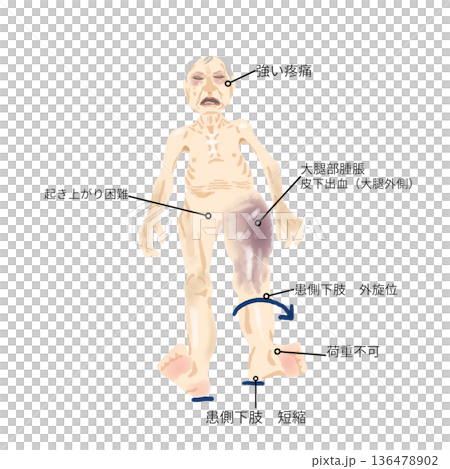 大腿骨転子部骨折の身体所見|外旋位・短縮・皮下出血・起き上がり困難イラスト 大腿骨転子部骨折の身体所見|外旋位・短縮・皮下出血・起き上がり困難イラスト 136478902