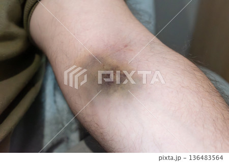 Bruise on arm after blood test, hematoma 136483564