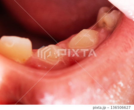 Close-up view of child oral cavity showing permanent teeth erupting behind primary teeth, dental development stage of mixed dentition 136506627