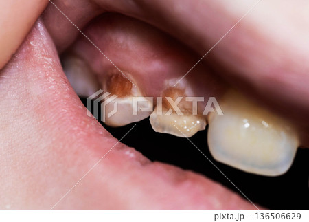 Close-up view of child mouth showing severe dental decay and enamel hypoplasia on upper front teeth caused by excessive sugar intake Close-up view of child mouth showing severe dental decay and enamel hypoplasia on upper front teeth caused by excessive sugar intake 136506629