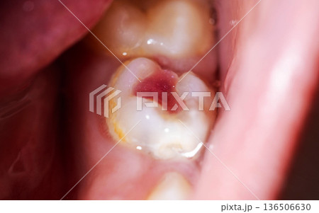 Chipped molar tooth of child with bright red colored dental filling applied, close-up macro view of pediatric dental restoration procedure Chipped molar tooth of child with bright red colored dental filling applied, close-up macro view of pediatric dental restoration procedure 136506630