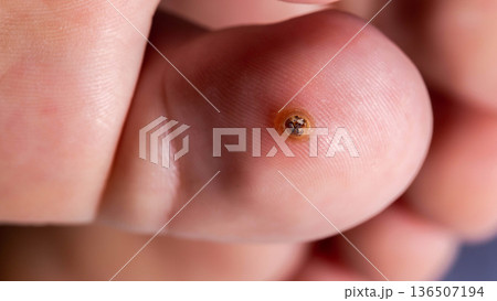 Verruca On The Tip Of A Toe. A Wider Perspective Showing The Foot And Surrounding Skin. 136507194