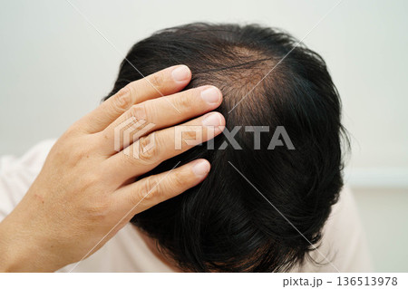 Bald in the middle head and begin no loss hair glabrous of mature man. 136513978