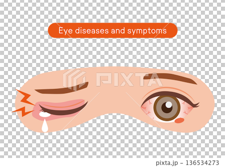 目の病気と症状 136534273