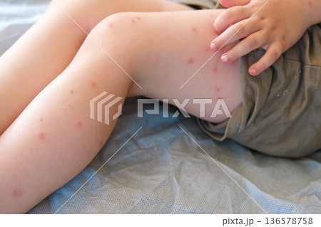 Child scratch body has sensitive itchy skin. Bodily rash. Kid allergy closeup. Little baby scratches eruption. Irritation, hive. Pruritus. Mosquito insect bite. Red from sunburn, Seborrheic Dermatitis 136578758