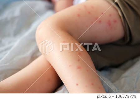 Child scratch body has sensitive itchy skin. Bodily rash. Kid allergy closeup. Little baby scratches eruption. Irritation, hive. Pruritus. Mosquito insect bite. Red from sunburn, Seborrheic Dermatitis 136578779