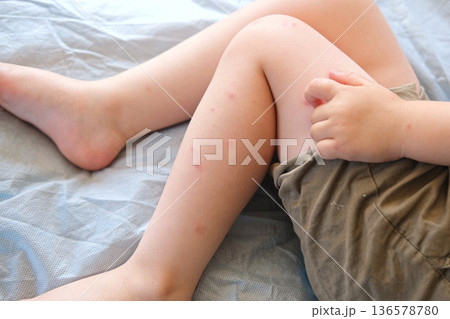 Child scratch body has sensitive itchy skin. Bodily rash. Kid allergy closeup. Little baby scratches eruption. Irritation, hive. Pruritus. Mosquito insect bite. Red from sunburn, Seborrheic Dermatitis 136578780