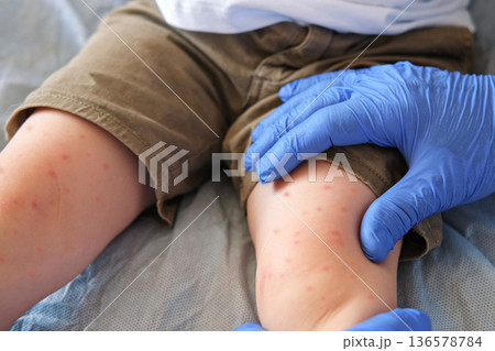Doctor examining child with bodily red rash. Kid allergy closeup. Little baby scratches an eruption. Nurse applies special cream to atopic skin. Dermatitis, irritation, hive. Pruritus. Mosquito bites Doctor examining child with bodily red rash. Kid allergy closeup. Little baby scratches an eruption. Nurse applies special cream to atopic skin. Dermatitis, irritation, hive. Pruritus. Mosquito bites 136578784