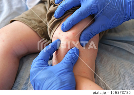 Doctor examining child with bodily red rash. Kid allergy closeup. Little baby scratches an eruption. Nurse applies special cream to atopic skin. Dermatitis, irritation, hive. Pruritus. Mosquito bites Doctor examining child with bodily red rash. Kid allergy closeup. Little baby scratches an eruption. Nurse applies special cream to atopic skin. Dermatitis, irritation, hive. Pruritus. Mosquito bites 136578786