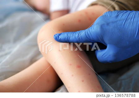 Doctor examining child with bodily red rash. Kid allergy closeup. Little baby scratches an eruption. Nurse applies special cream to atopic skin. Dermatitis, irritation, hive. Pruritus. Mosquito bites 136578788