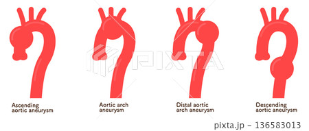 大動脈瘤のイラスト　Illustration of an aortic aneurysm 136583013