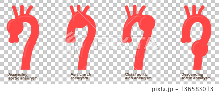主動脈瘤示意圖 主動脈瘤示意圖 136583013