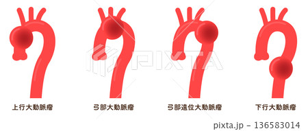 大動脈瘤のイラスト　Illustration of an aortic aneurysm 136583014