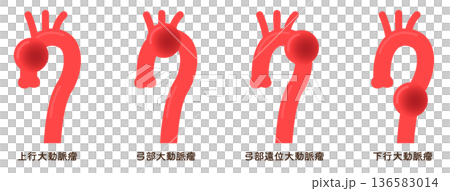 大動脈瘤のイラスト　Illustration of an aortic aneurysm 136583014